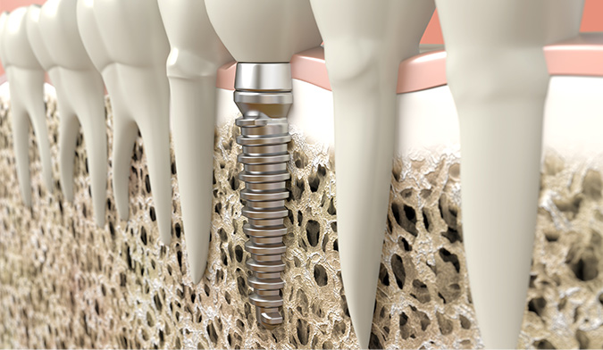 Bone Grafting